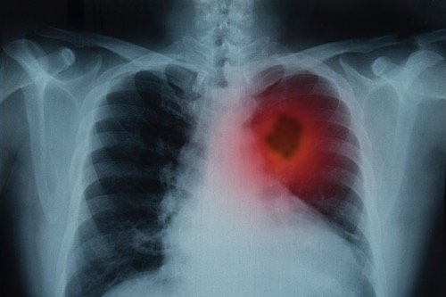 lungCancer